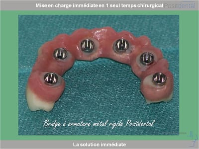 Chirurgie guidée mise en charge immédiate 0025 eyfkvs - Eugenol