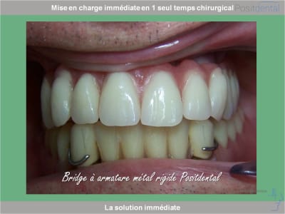 Chirurgie guidée mise en charge immédiate 0028 wet9xw - Eugenol