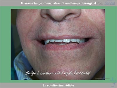 Chirurgie guidée mise en charge immédiate 0030 fblfoo - Eugenol