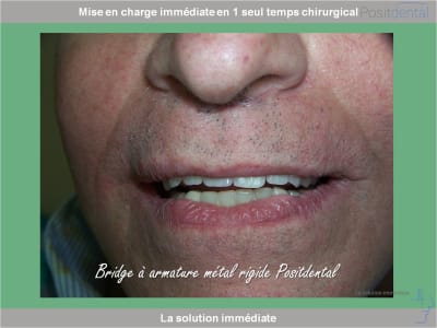 Chirurgie guidée mise en charge immédiate 0031 weytax - Eugenol