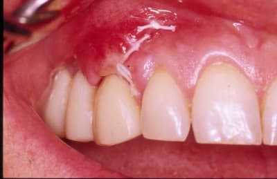 Cica opotea - Eugenol