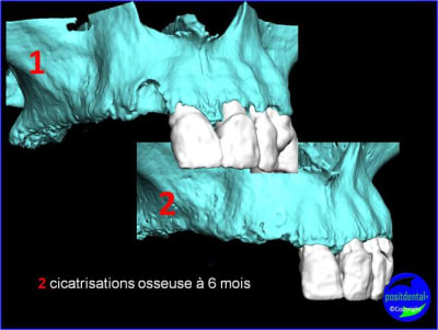 Cicatrisations osseuse   6 mois s8gen4 - Eugenol