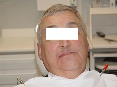 Classe iii avant traitement uasubx - Eugenol