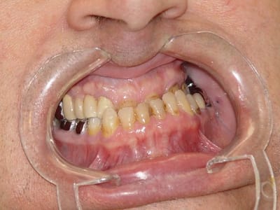Classe iii avant traitement vue endo bucale myikgy - Eugenol