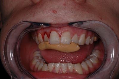 Cle v2vurs - Eugenol