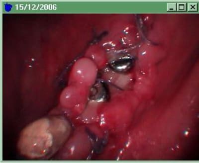 Complication ggocwo - Eugenol