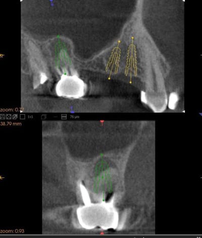 Cone beam sinus2 qpzzln - Eugenol