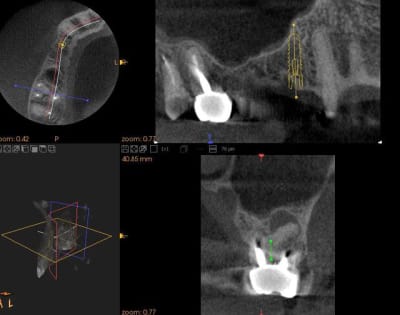 Cone beam sinus lahzeb - Eugenol