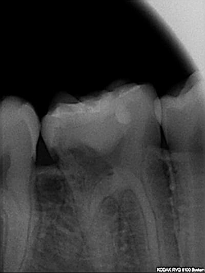 Cone radio en distal vxurgy - Eugenol