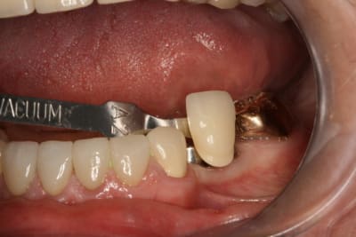 Couleur implant 34 35 cw6kah - Eugenol