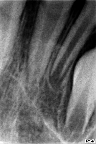 Couronne 8 ans cvvd6z - Eugenol