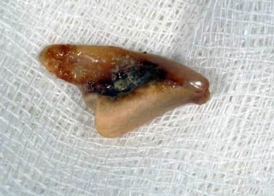 Dent01 sovins - Eugenol