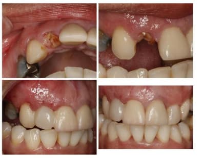 Dent 12 exo implant greffe  custom  vbkyh6 - Eugenol