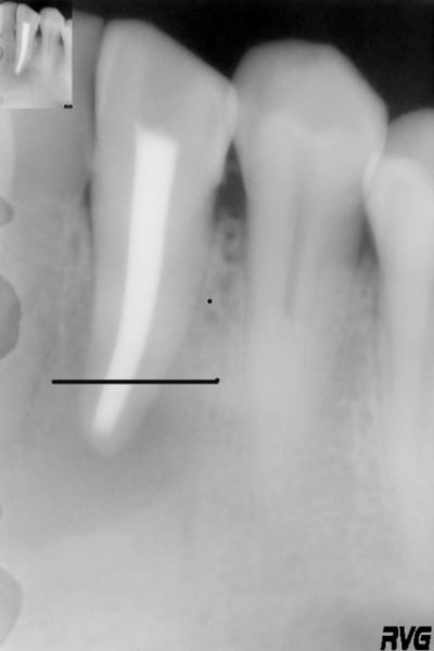 Dent 33 w1munp - Eugenol