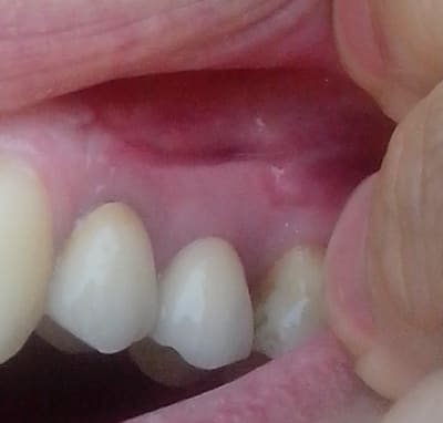 Dent hvew2y - Eugenol