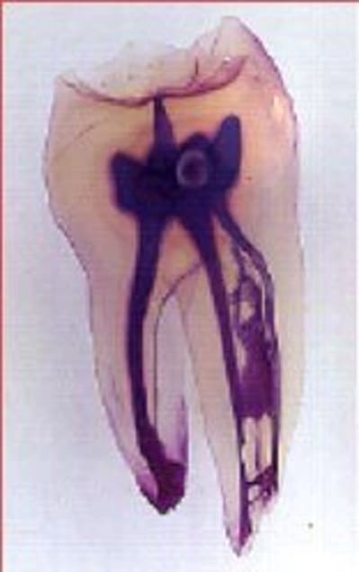 Dent pvdorf - Eugenol