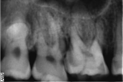 Dent wvwoxh - Eugenol