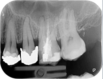 Dentisterie irl rx3fmm - Eugenol