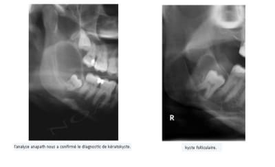 Diagnostic différentiel vnokoc - Eugenol