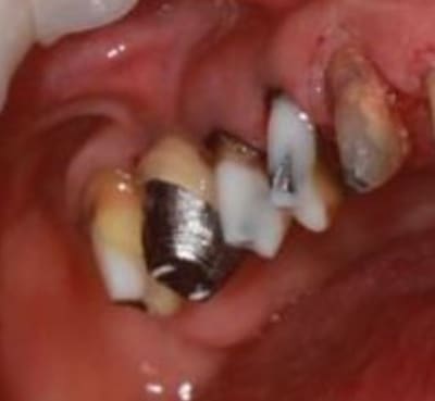 Dr le de pilier.. - Eugenol