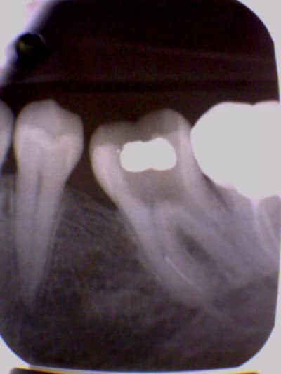 Endo1 nswox3 - Eugenol