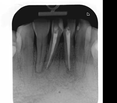 Endo1 pdeppv - Eugenol