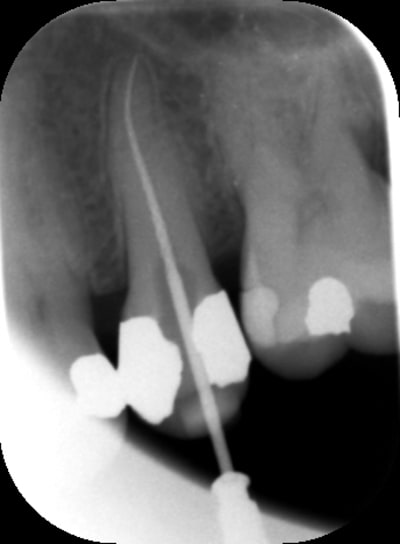 Endo2 ijoihl - Eugenol