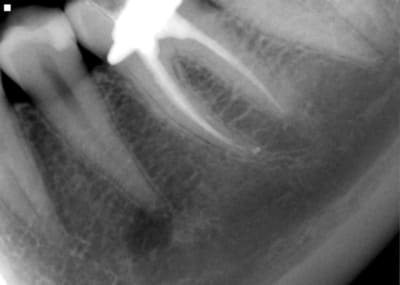 Endo 36 wave one k5mr0c - Eugenol