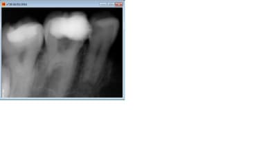 Endo 3 whlpmn - Eugenol