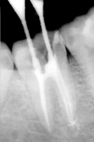 Endo 47 bka74j - Eugenol