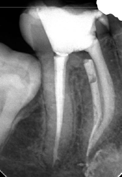 Endo 4  4  ime cass e fin nbax19 - Eugenol