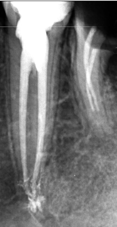 Endo 9  2  fin fsapdn - Eugenol