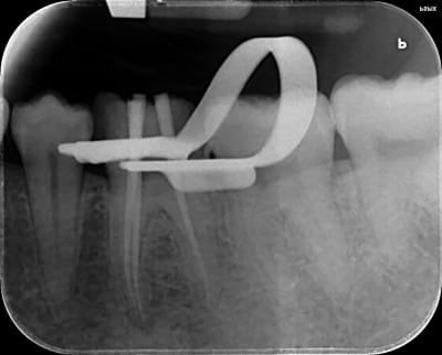 Endo cone en miklw8 - Eugenol