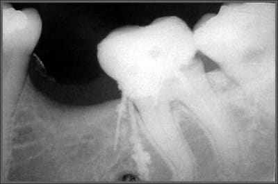 Endo ratée 1 sm7jtv - Eugenol