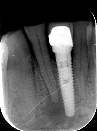 Endoimplant dhxqdg - Eugenol