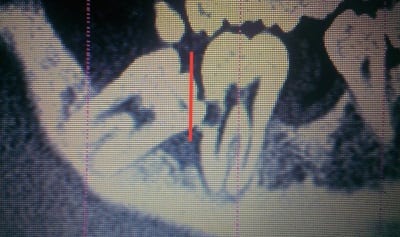 Extraction xmresx - Eugenol