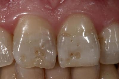 Facette  1  toe21m - Eugenol