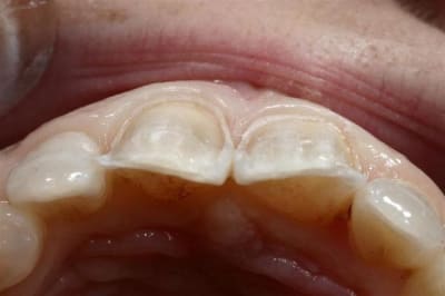 Facette  2  oonzsd - Eugenol