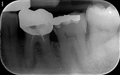 Fracture am unakj0 - Eugenol