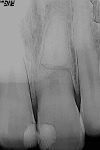 Fracture frgkzu - Eugenol