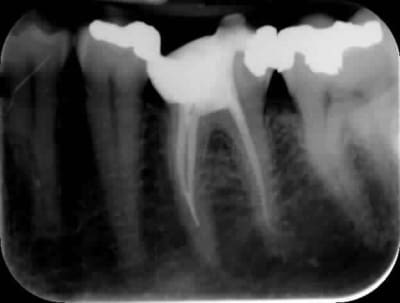 Fracture kaeyte - Eugenol