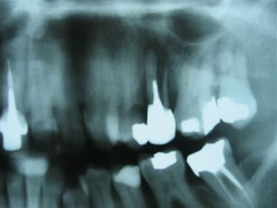 Fracture vt1rdw - Eugenol