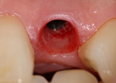 Gingival profil mzgbax - Eugenol