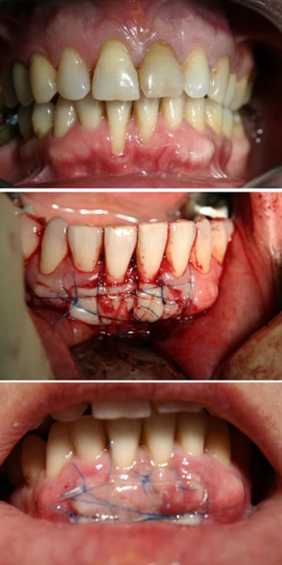 Greffe av ap ci6ore - Eugenol