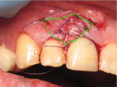Greffe 02 kskvyz - Eugenol