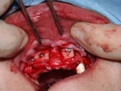 Greffe en place kssynr - Eugenol