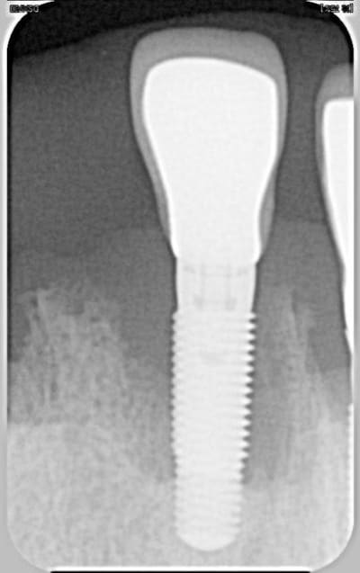 Identif implant qfsess - Eugenol