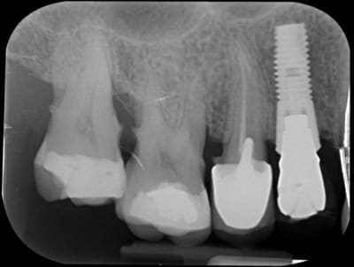 Identification implant maojmu - Eugenol