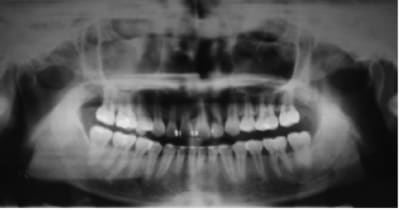 Impacted5 sciemd - Eugenol