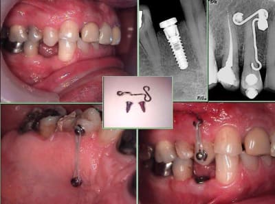 Implant ingression a5yvap - Eugenol